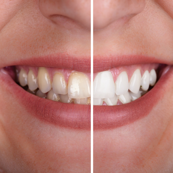 whiter teeth