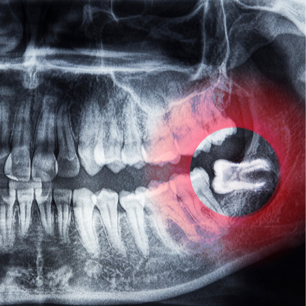 tooth removal